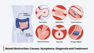 Bowel obstruction - Causes, Symptoms, Diagnosis and Treatment